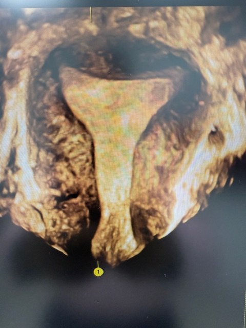 3D Uterus
