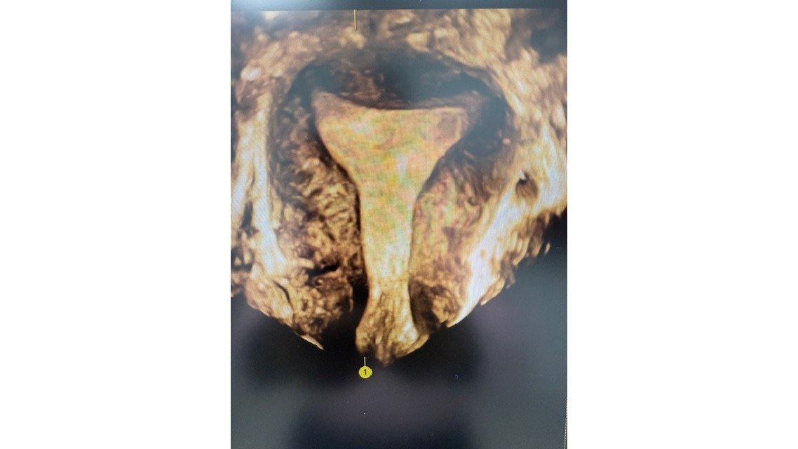 Benefits of Laparoscopic Fibroid Surgery