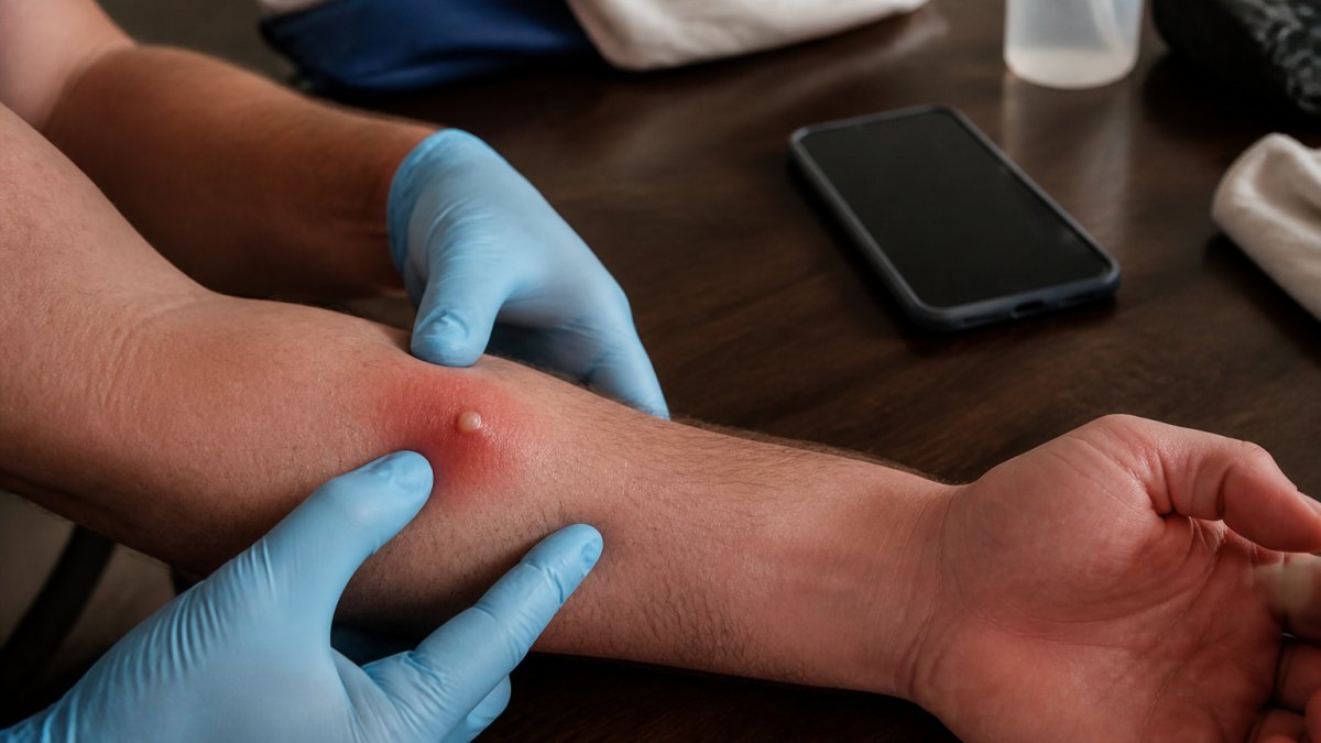 Close-up of a person's forearm showing a red, swollen skin bump being examined with a gloved hand, with a smartphone nearby showing a symptom checklist