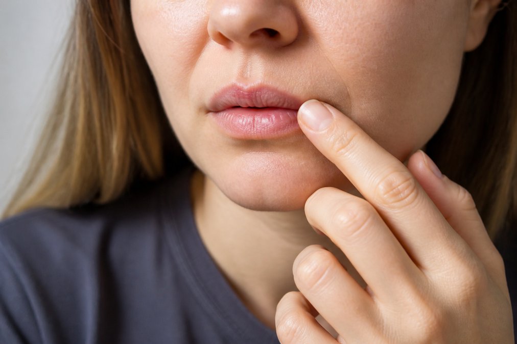 Close-up of a person's lip showing early-stage cold sore symptoms with redness and slight swelling, person touching their lip with concern and awareness