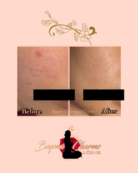 Acne Scar Before And After