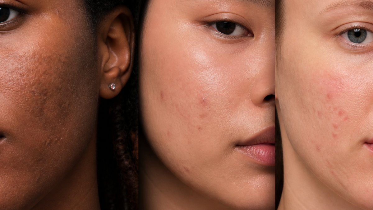 Close-up of diverse skin tones showing different types of acne scarring textures, depressed scars, and post-inflammatory hyperpigmentation marks under natural lighting