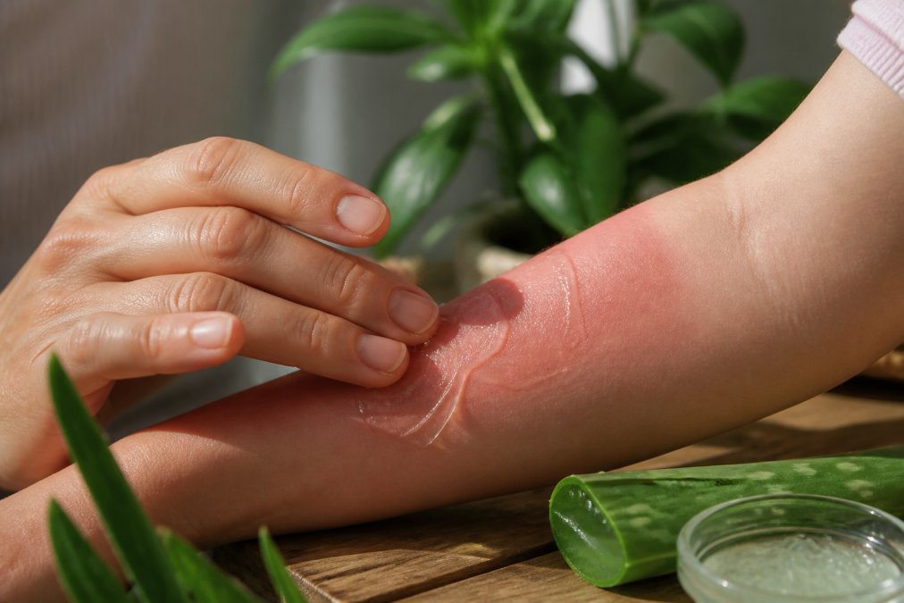 Close-up of hands gently applying clear aloe vera gel to a sunburned forearm, fresh aloe vera leaf and green plant blurred in the background, soft natural daylight