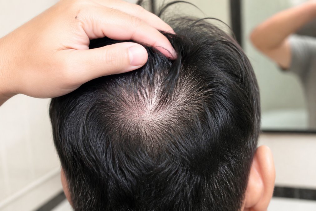 Close-up of a person's scalp showing visible thinning hair at the crown, with a hand gently parting the hair to reveal the scalp under bright bathroom lighting
