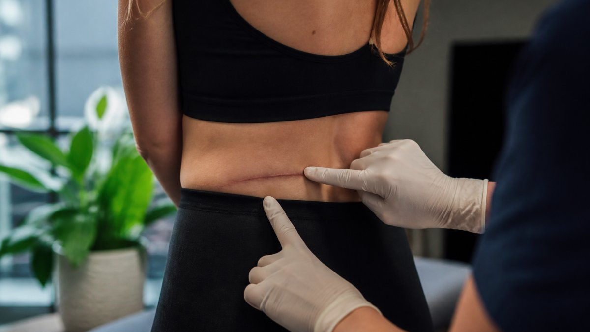 Avoiding Dog Ears After Liposuction: Prevention & Care