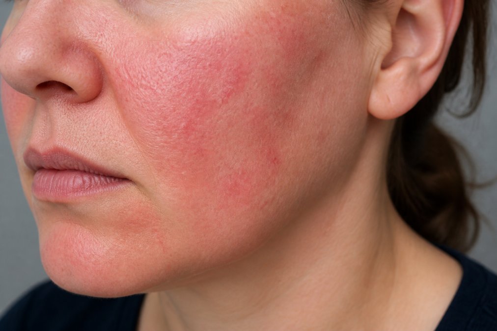 Close-up of a person's red, irritated facial skin showing visible inflammation and sensitivity reactions from harsh cleansing products