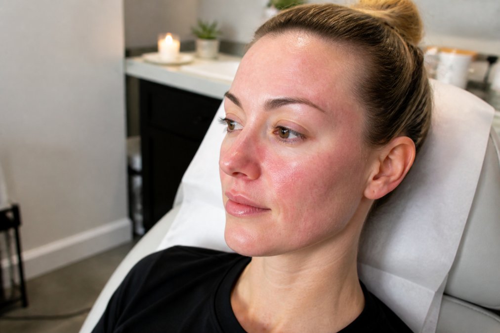 Infographic timeline showing facial redness and swelling before after microneedling recovery steps.