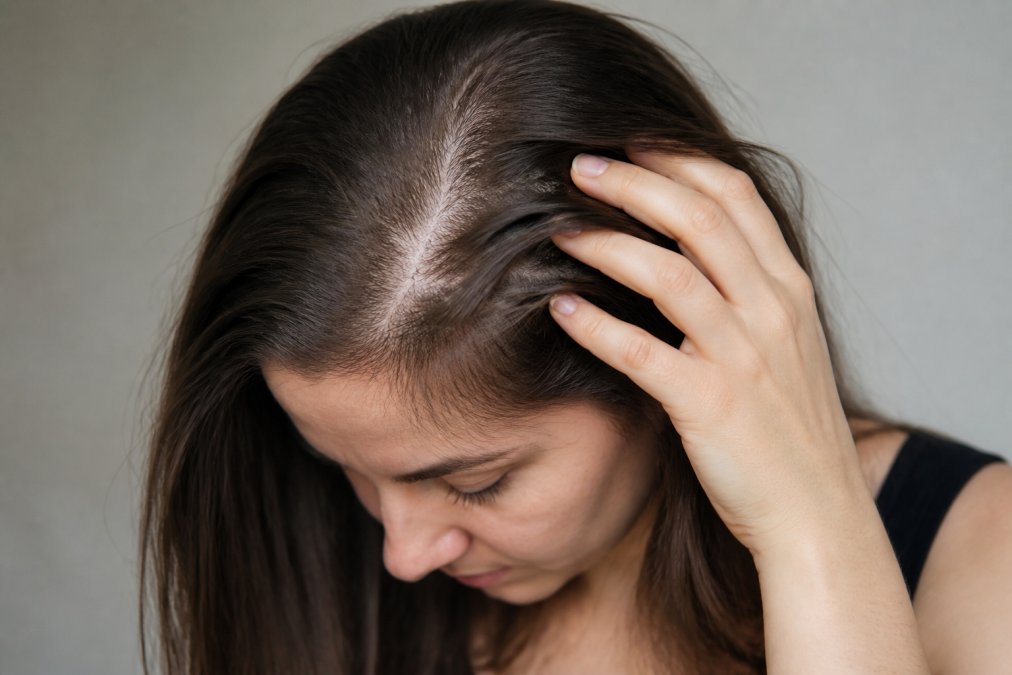 Close-up of a woman with fine, thin hair gently touching her scalp, showing natural density and texture in soft, natural lighting