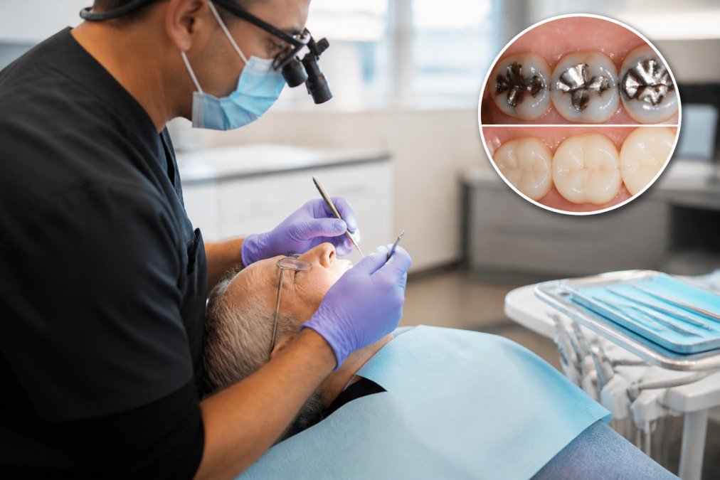 Benefits of Replacing Old Silver Fillings