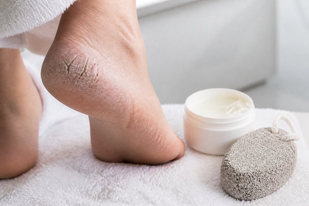 Dry cracked heel resting on a white towel next to a jar of moisturizer and a pumice stone in a bright bathroom