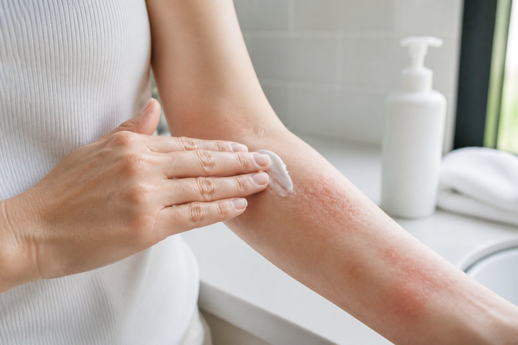 Close-up of hands applying a white, fragrance-free lotion to a forearm with mild eczema patches, soft natural light, clean bathroom counter with a pump bottle in the background