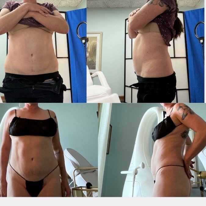 Best Med Spa for Body Contouring: 2026 Guide