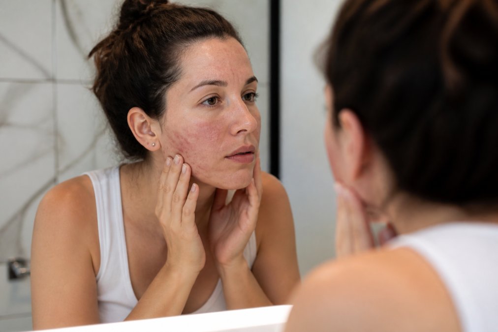 Woman examining her face closely in a mirror, showing redness and blemishes on cheeks and forehead under natural bathroom lighting, with various skin textures visible
