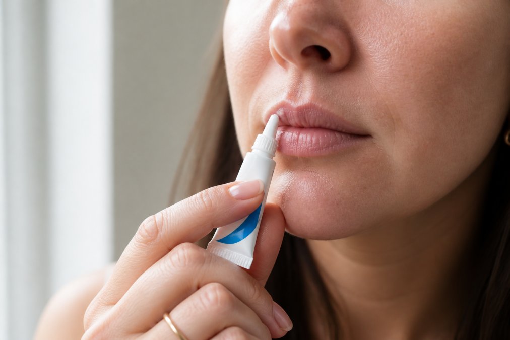 Close-up of a person's hand applying a small tube of topical cold sore treatment to their lip area, soft natural window lighting, clean clinical feel with white background