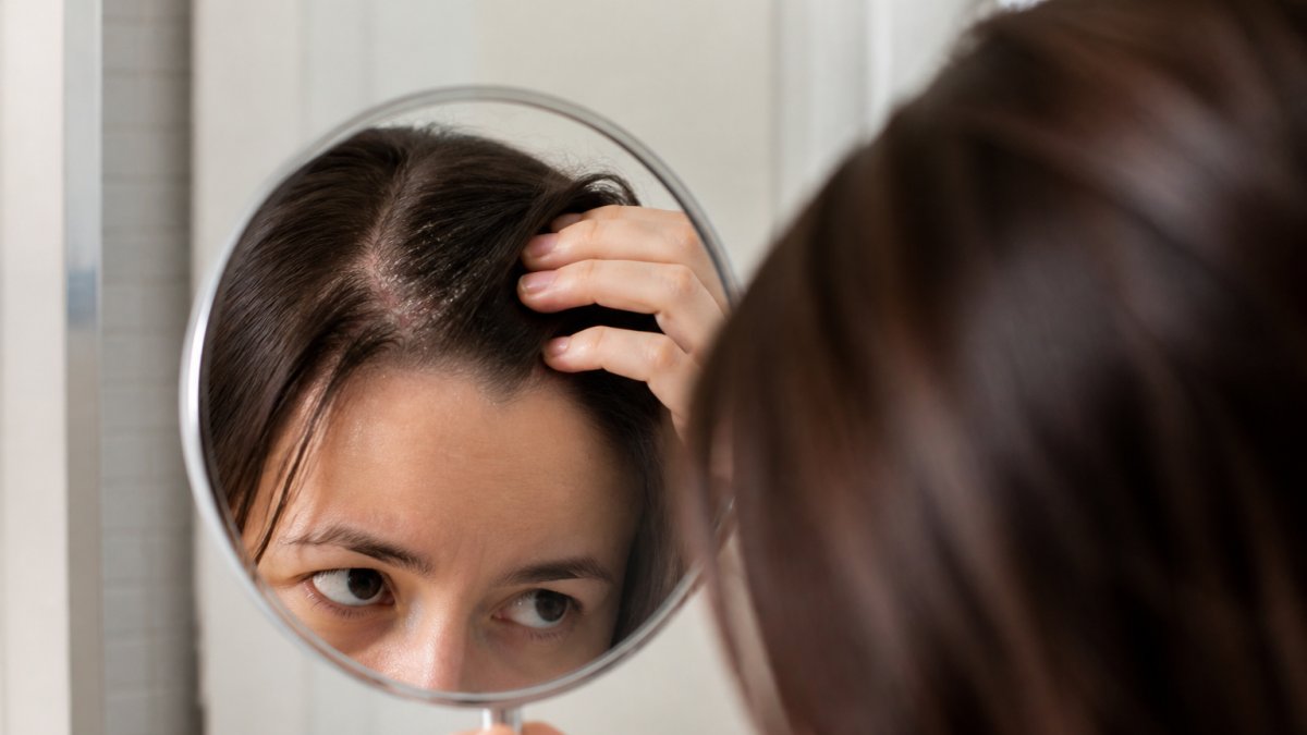 Close-up of a person examining their scalp in a mirror, showing visible flakiness and redness on the scalp area near the hair roots under natural bathroom lighting