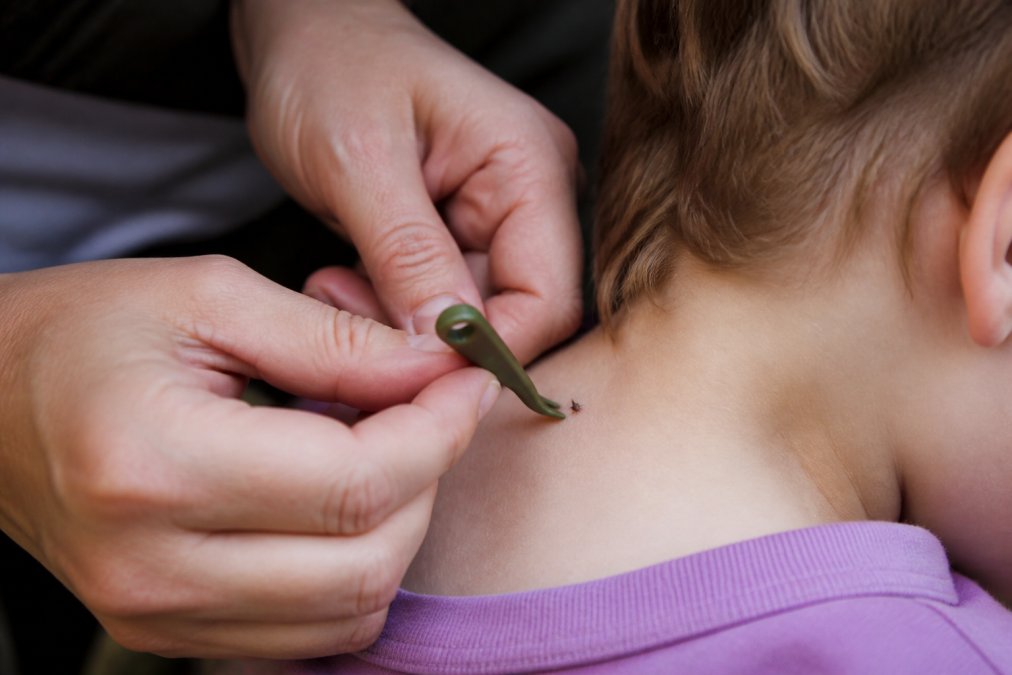 Close-up of hands using The Original Tick Key tool to carefully remove a tick from child's skin, demonstrating proper removal angle and technique
