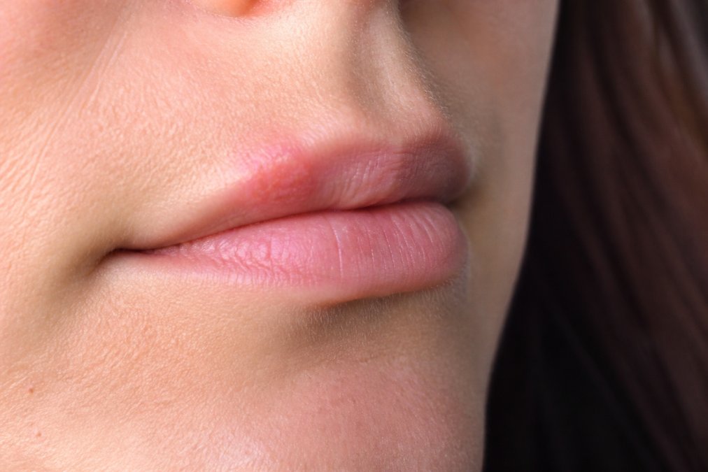Close-up of a person's lip showing early redness and slight swelling during the tingling stage of a cold sore, with natural daylight illuminating the affected area