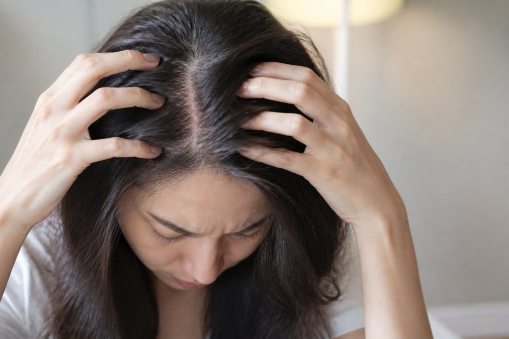 Causes of Scalp Inflammation in Women
