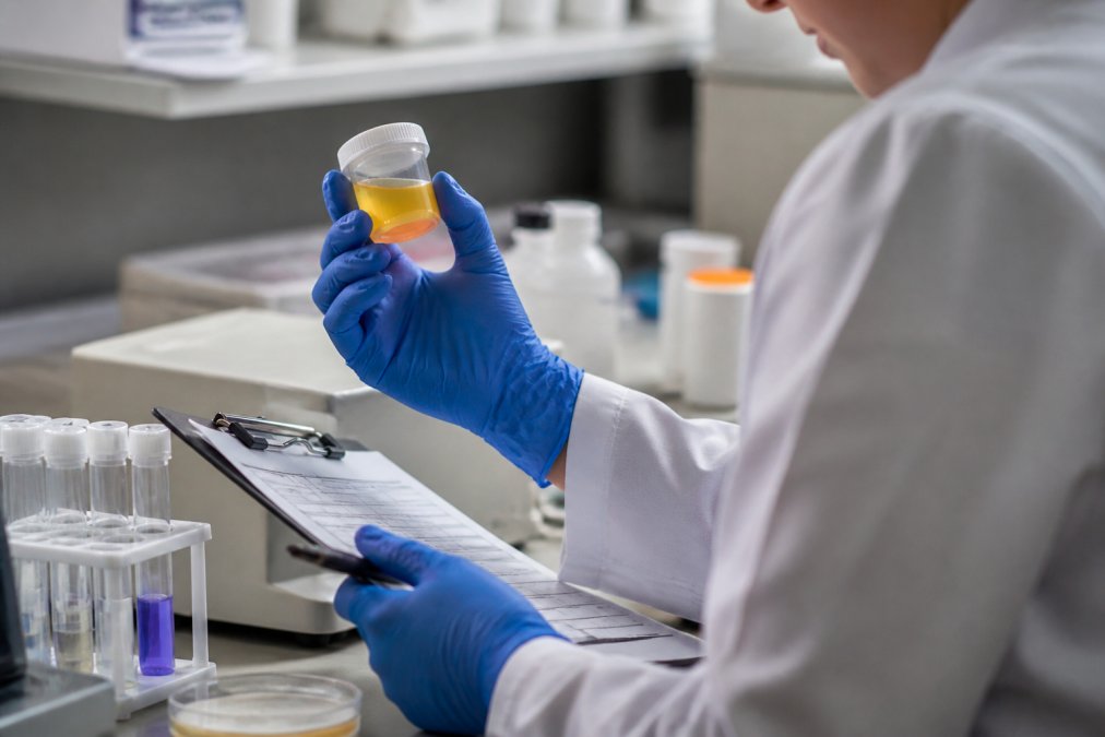 Lab technician analyzing a urine sample during a cbd lotion drug test procedure in a clinical laboratory setting