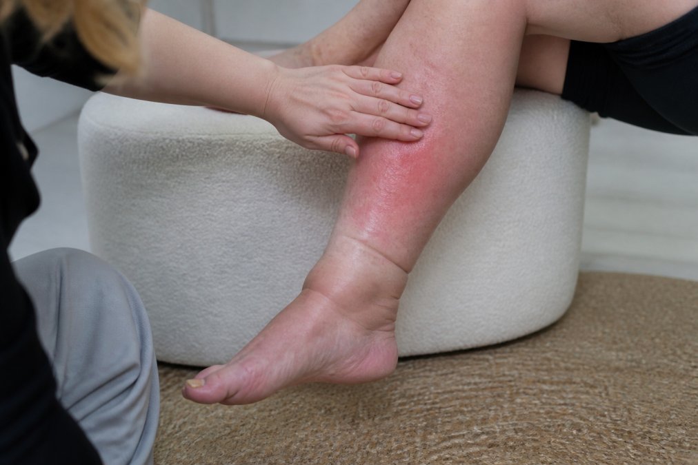 Cellulitis effectief behandelen: een integrale aanpak