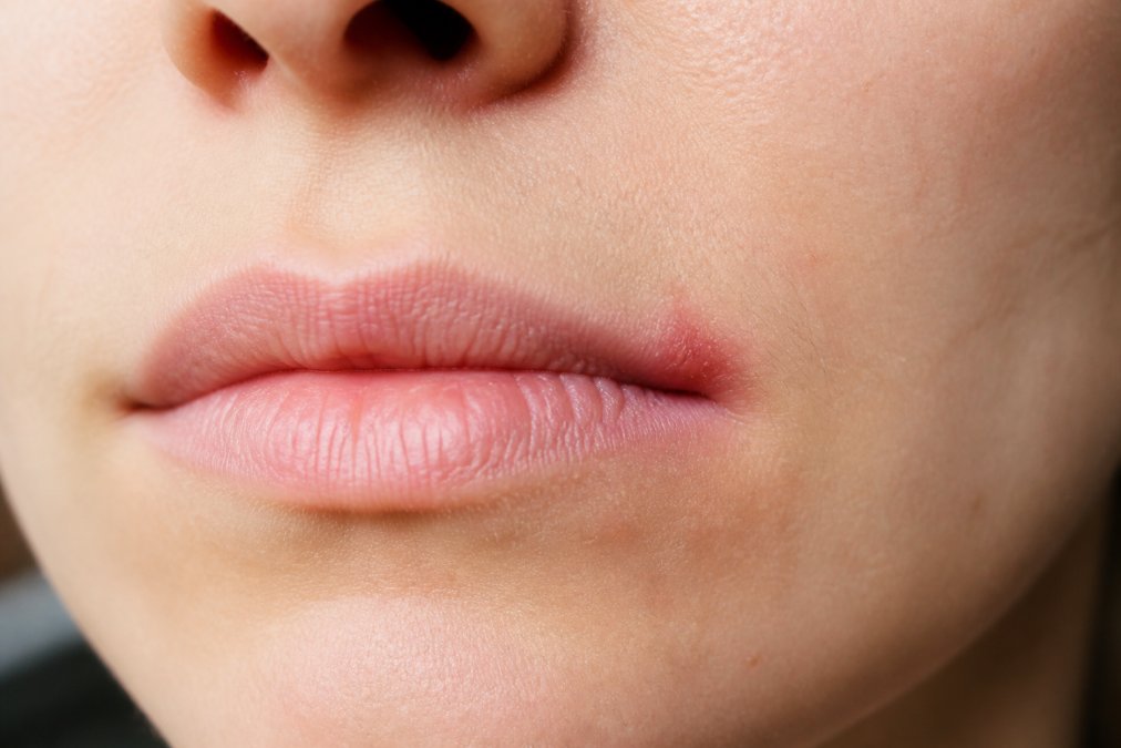 Close-up of person's lips showing early redness and slight swelling at corner of mouth, with focused lighting highlighting the prodromal stage before visible blistering