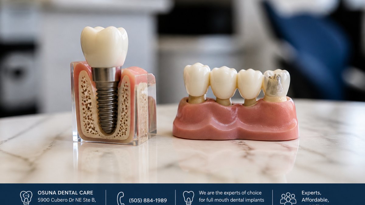 Dental Implant vs Bridge for Missing Tooth