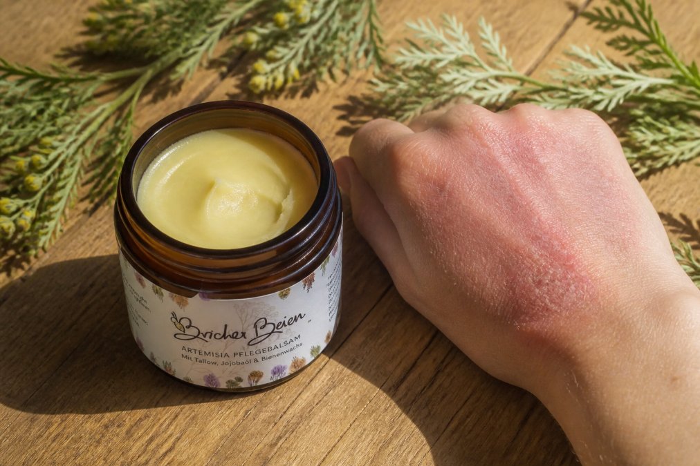 Offener 100ml-Tiegel mit cremigem, gelblich-beigem Balsam, daneben eine Hand mit trockener, geröteter Haut am Handrücken, warmes natürliches Licht von oben