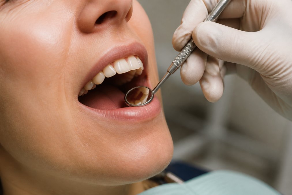 Dentist using a mirror to examine gums where the oral microbiome can enter the bloodstream