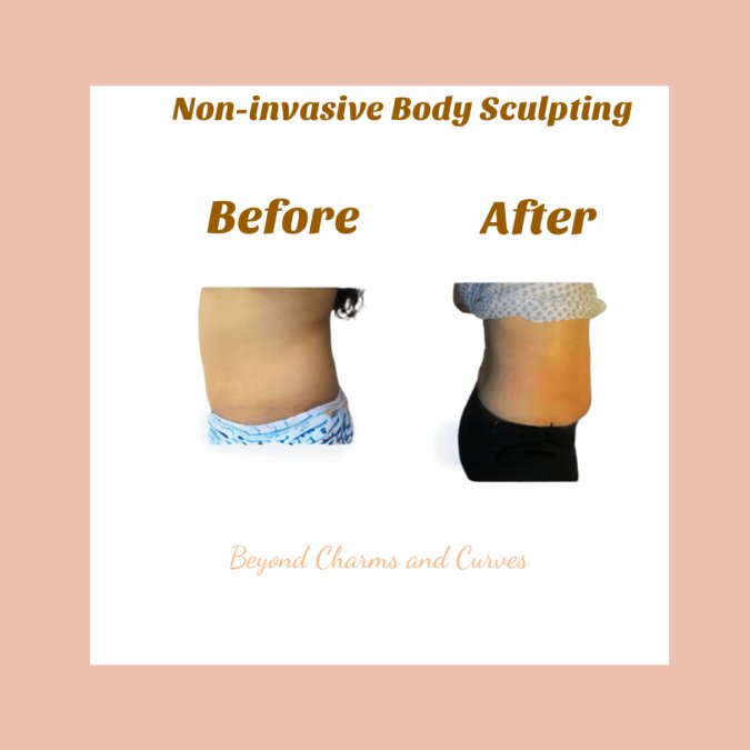 Downtime for Non Invasive Body Sculpting: What to Expect