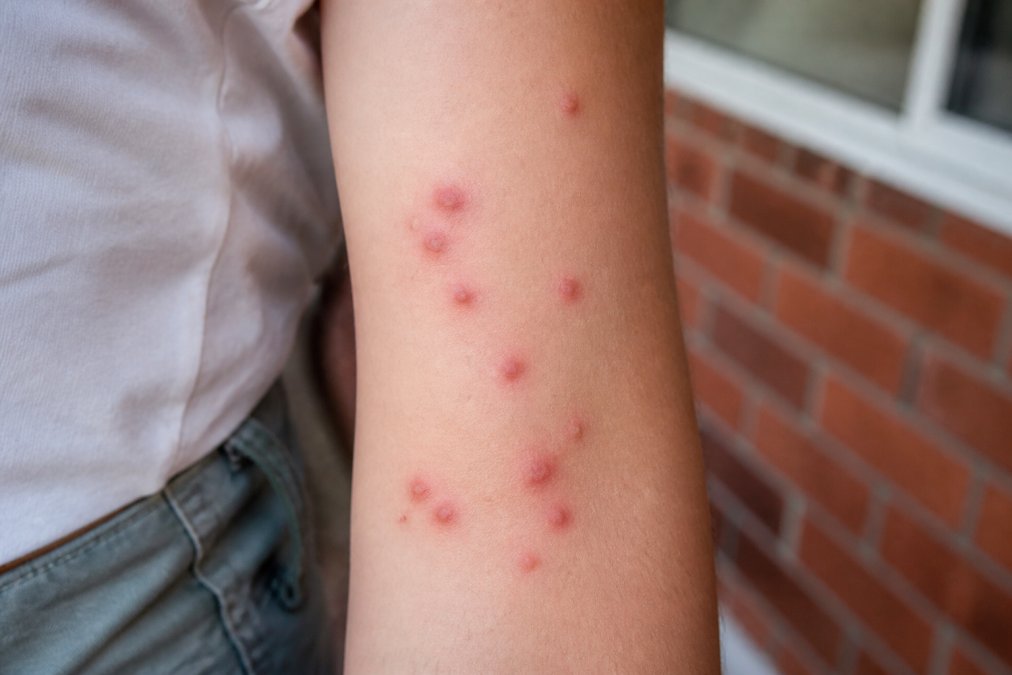 Close-up of bed bug bites showing characteristic red welts and clustered marks on human skin on an arm in natural daylight