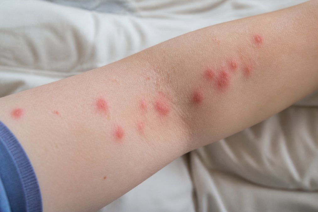 Close-up of characteristic red bed bug bite marks clustered on human arm skin, showing inflammation and welts on pale complexion with natural daylight