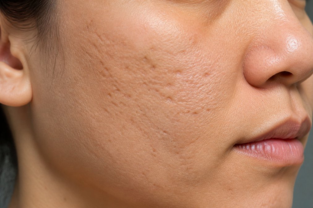 Close-up of skin texture showing different types of atrophic scarring patterns on a person's face, with natural lighting to highlight depth variations and pitted appearance