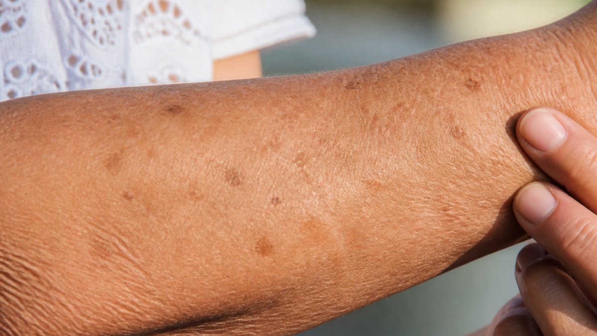 Infographic illustrating signs of sun damaged skin, including brown spots, uneven texture, and fine lines.