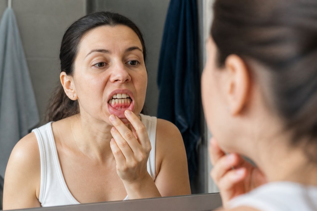 Person examining their gums in a bathroom mirror, showing areas of redness and inflammation with natural lighting