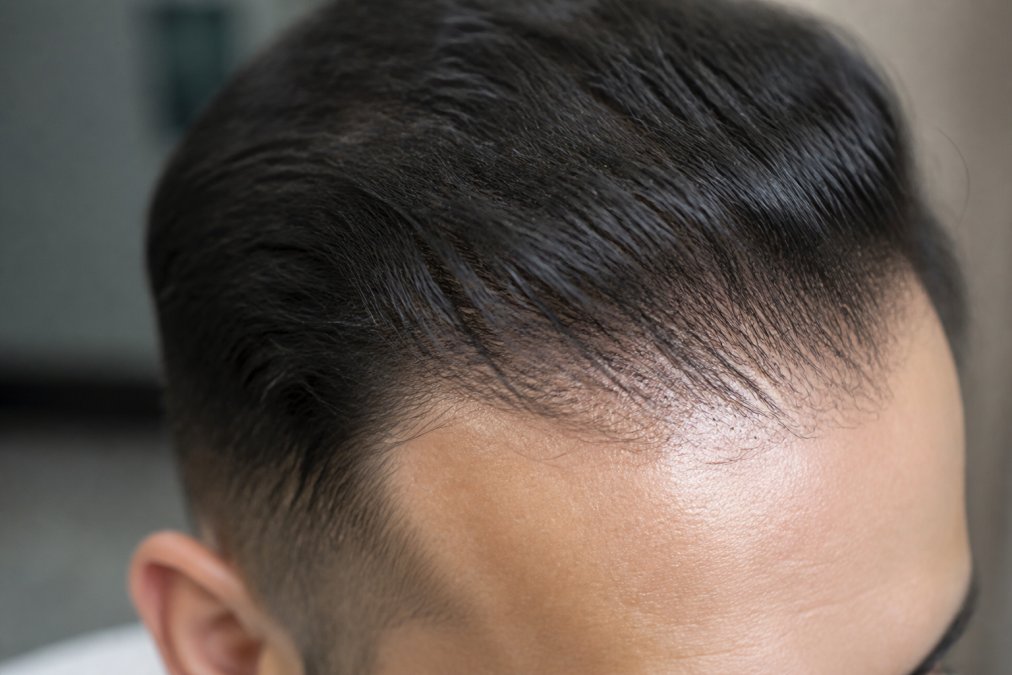Close-up of scalp showing natural hair density with healthy follicles and hairline definition in natural lighting
