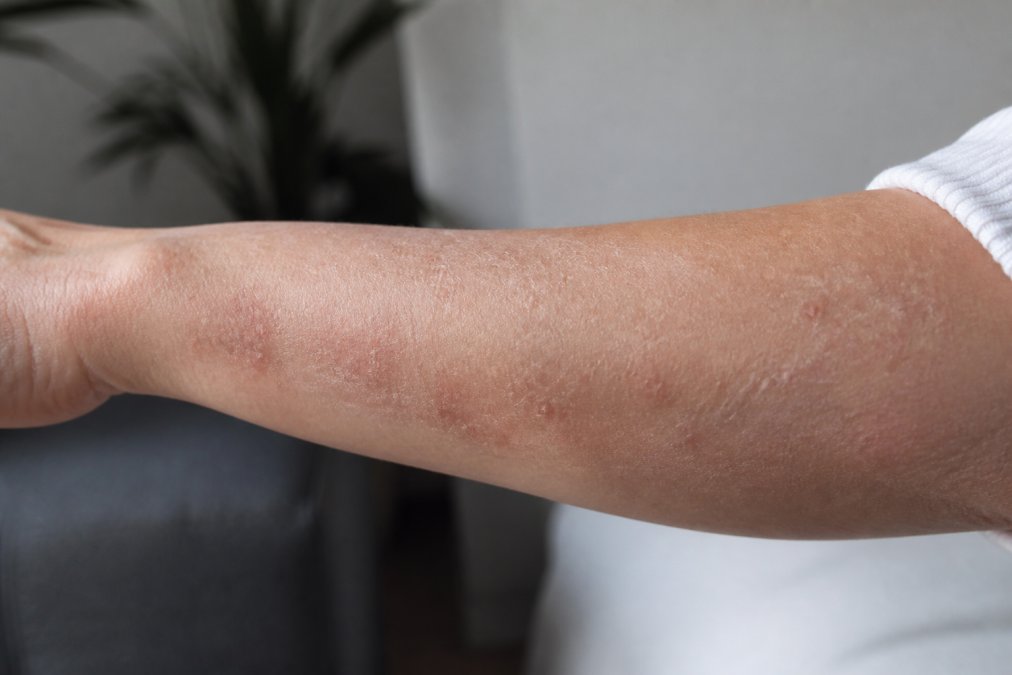 Close-up of dry, flaky skin on a person's forearm with visible irritation and redness, photographed in natural light against a soft neutral background