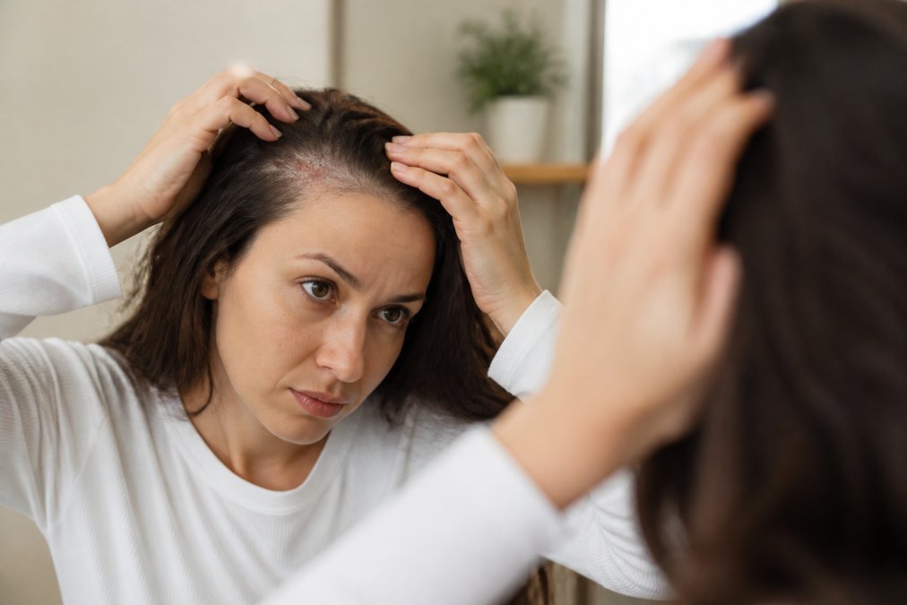 Holistic Treatment for Scalp Psoriasis: 7 Natural Steps
