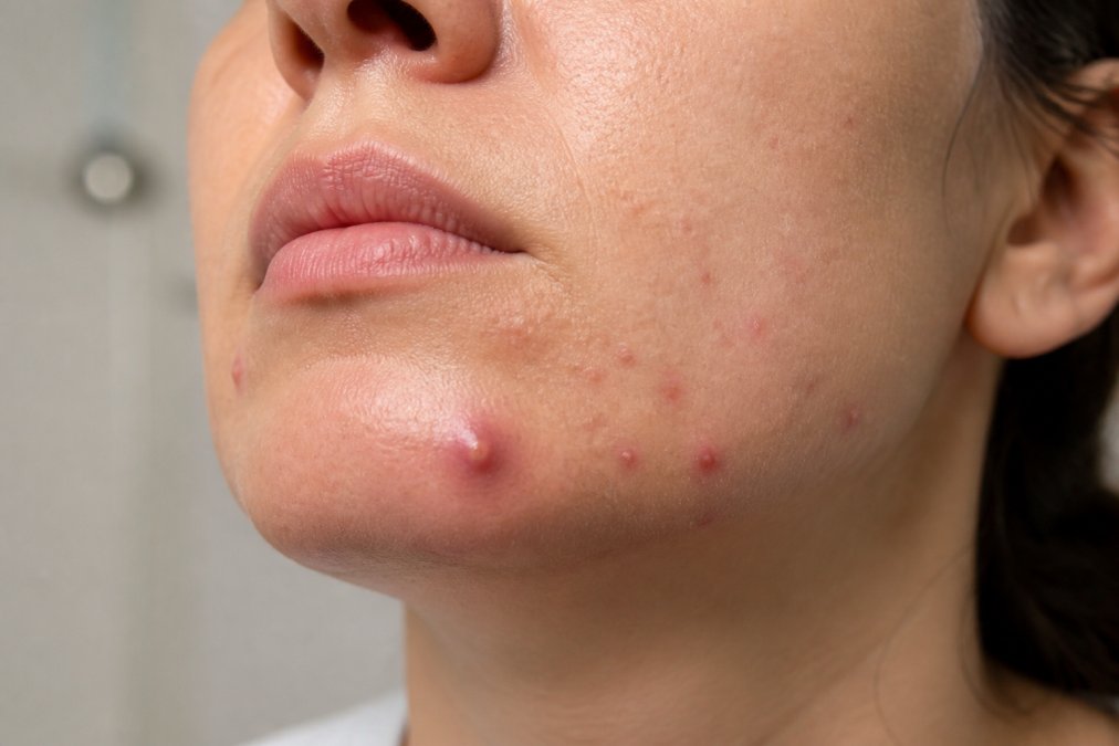 Close-up of lower face showing smaller inflammatory hormonal acne bumps along jawline contrasted with deeper, swollen cystic acne lesion on chin under clinical lighting