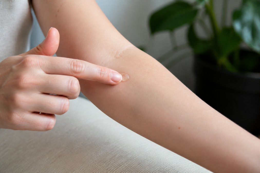 Close-up of a person's inner arm showing a small amount of peptide serum being applied with a fingertip for patch testing, natural indoor lighting on pale skin