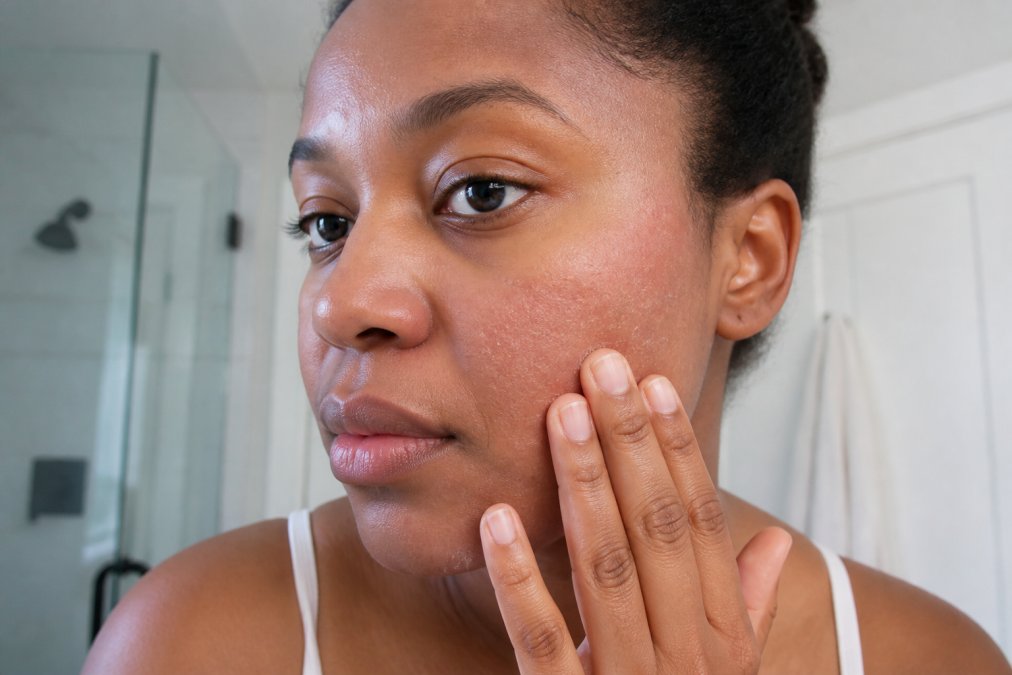 Close-up of a woman gently touching her cheek in soft bathroom lighting, showing mild redness and flaky, dry patches on her skin