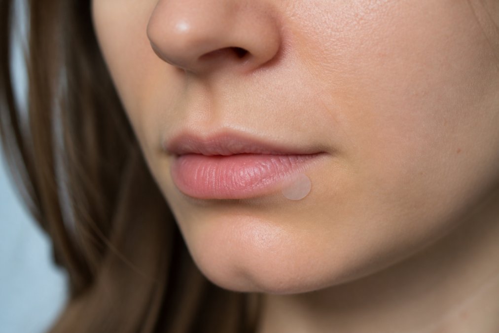 A small, thin hydrocolloid medicated patch placed on the corner of a person's lip, shown against clean, well-lit natural skin tone in soft daylight, illustrating how discreet the patch looks in daily life