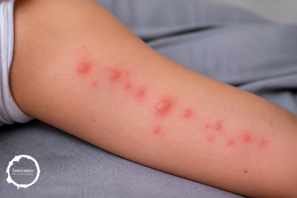 Close-up of raised red welts and bumps on skin showing linear and clustered bite patterns typical of bed bug bites in natural lighting