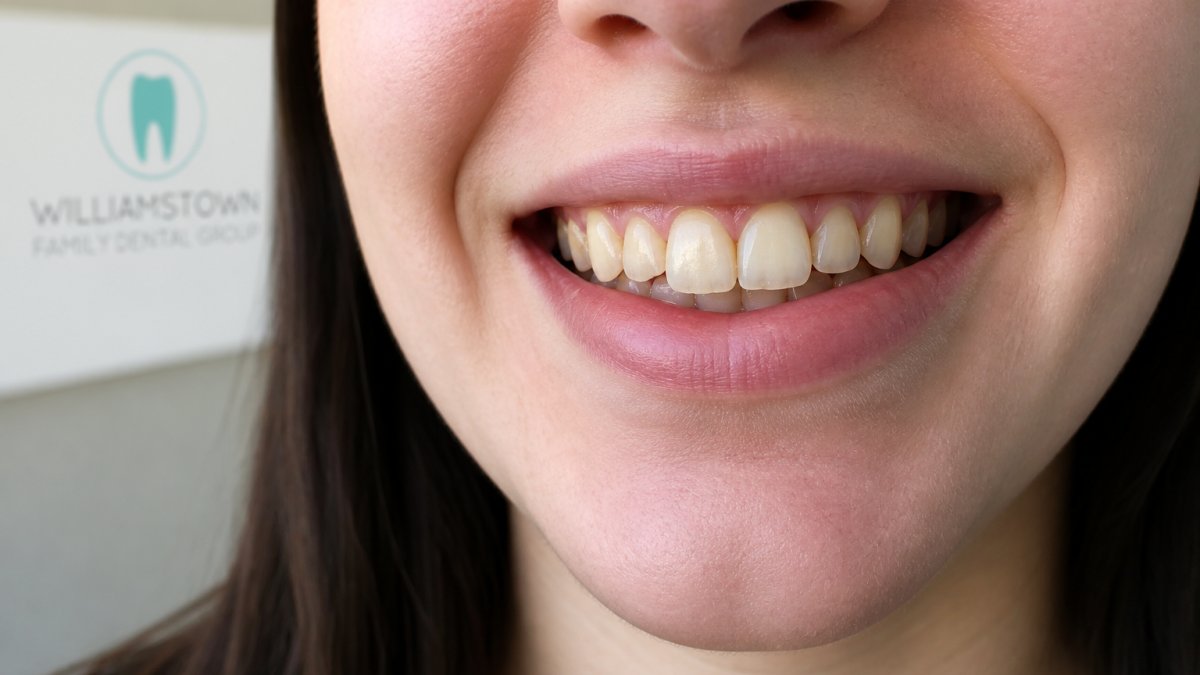 Close-up of person's smile showing discoloured, slightly chipped front teeth in natural daylight, demonstrating cosmetic concerns that veneers address