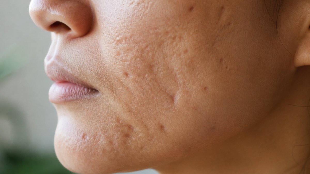Infographic diagram illustrating ice pick, boxcar, and rolling acne scarring patterns on facial skin.