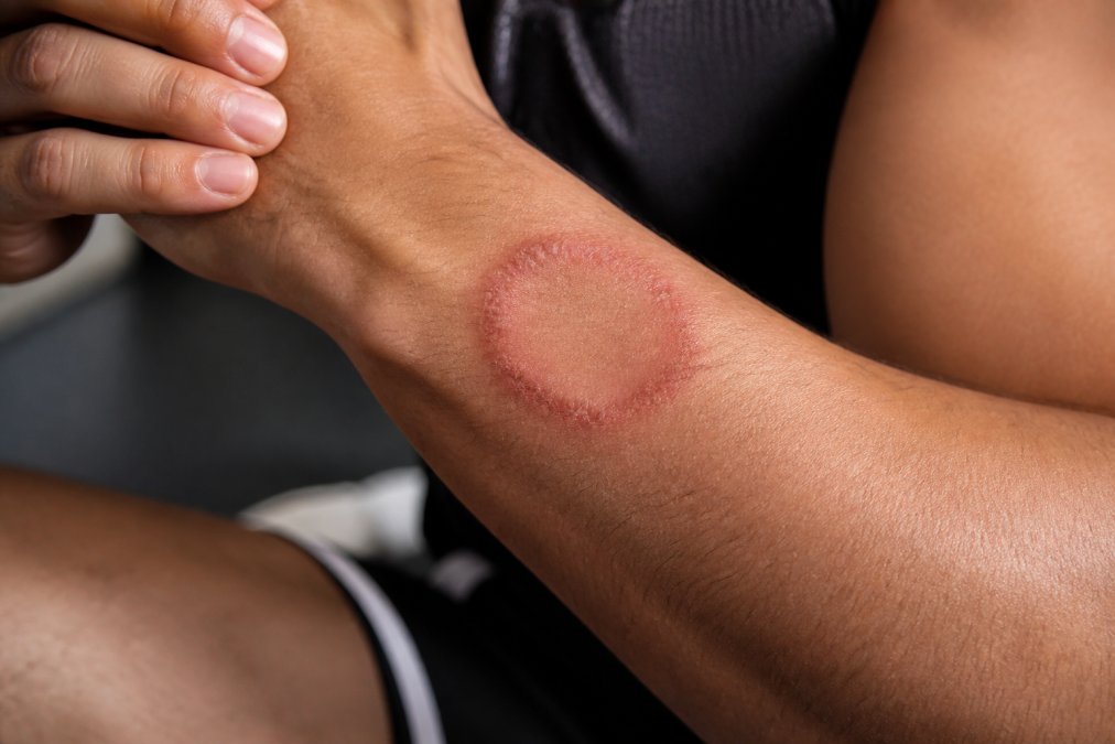 Close-up of a grappler's arm showing a red, ring-shaped rash with scaly edges characteristic of early ringworm infection on skin