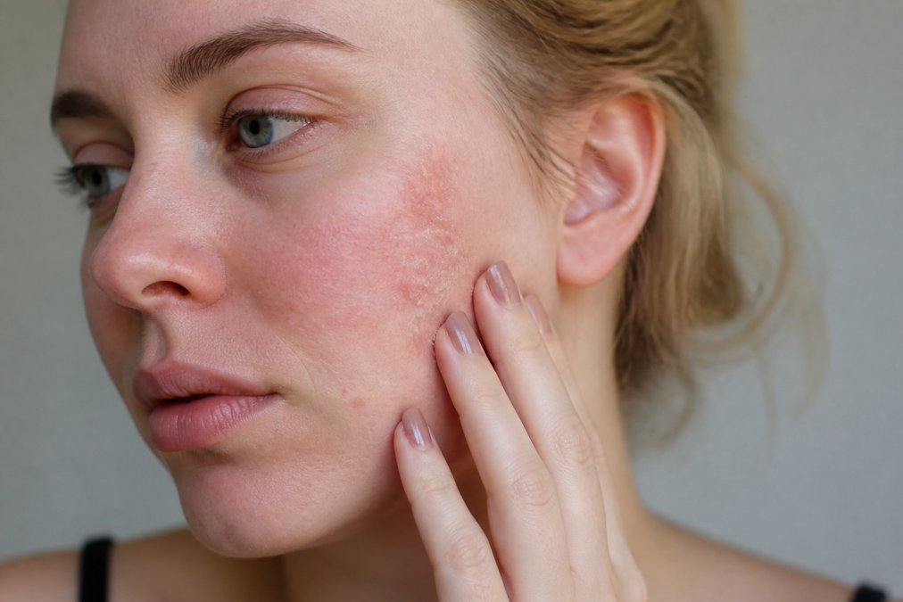 Professional illustration showing damaged skin barrier