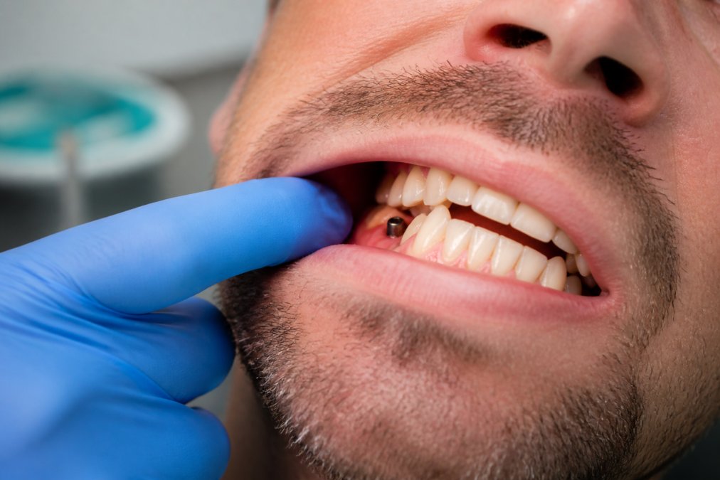 Close-up of a person's mouth showing gum inflammation and redness around an implant site with natural clinical lighting