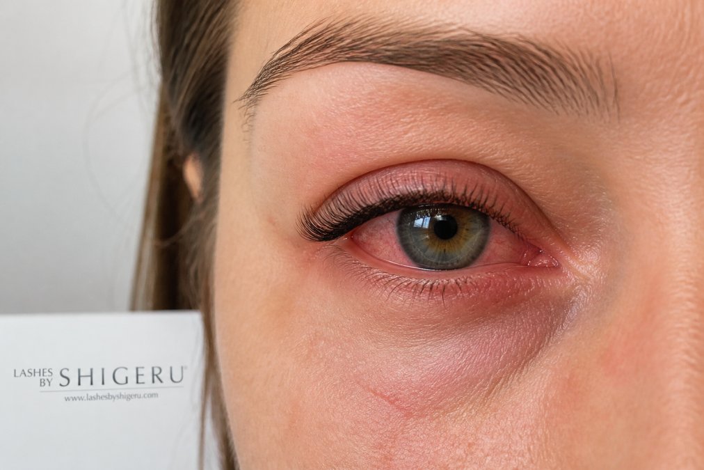 Close-up of person's eye showing mild redness and irritation around the lash line with natural lighting highlighting the sensitivity