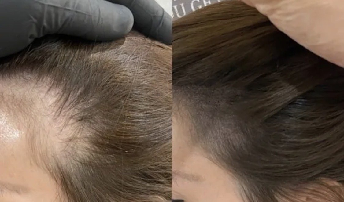 Scar Camouflage for Surgical Scars: Complete Guide