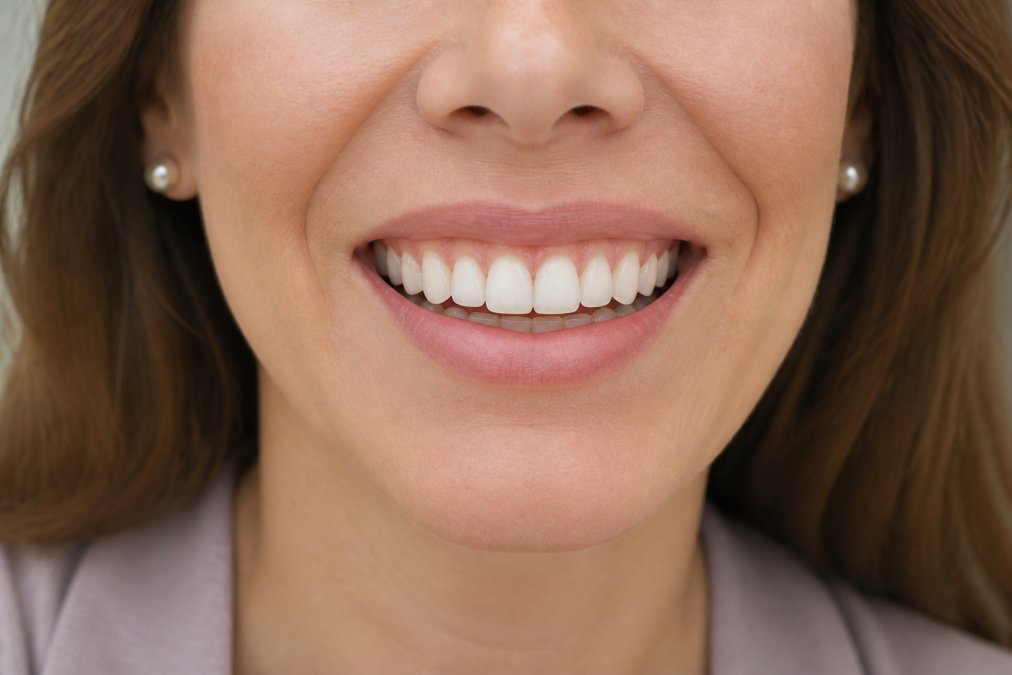 Close-up of patient's smile showing natural-looking dental implants with visible tooth structure and healthy gum line in bright clinical setting
